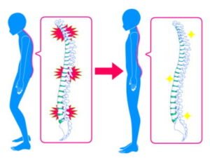 【公式】柏で「パーキンソン病の腰痛」専門の治療・整体