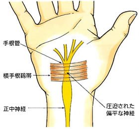 【公式】柏で『手根管症候群』専門の整体
