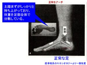 ひざの痛みの治療・整体　扁平足を治すことで膝の痛みを劇的に改善！