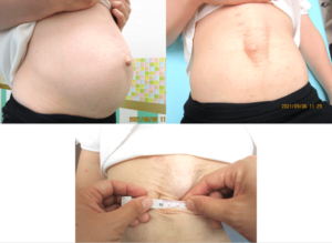 妊娠中（妊婦さん）の腹直筋離開も早期から治療が必須！