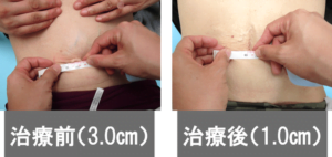 腹直筋離開 治療前後の比較