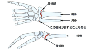 骨折後の関節の硬さ（関節拘縮）の整体