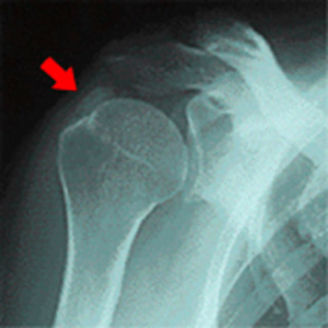 【公式】柏で「石灰沈着性腱板炎」専門の整体