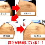 腹直筋離開が治った時の写真を公開中！