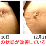 腹直筋離開でも背骨や肋骨・股関節を治療することが大事！