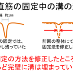 再発しない腹直筋離開のトレーニング方法
