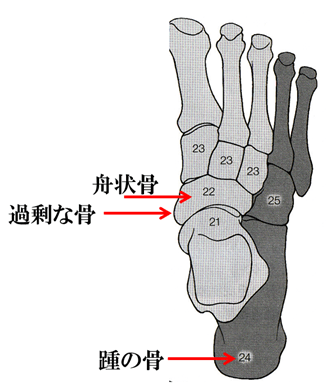 足の舟状骨と過剰な骨（外脛骨）