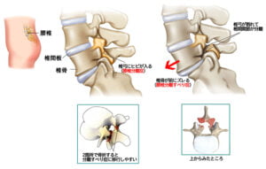 【公式】柏で「腰椎すべり症」専門の治療・整体