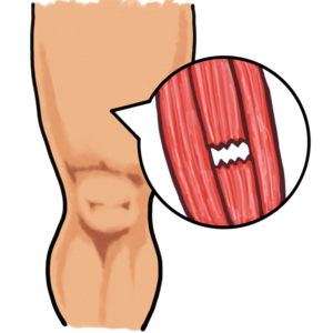 芸能人も通う柏の整体で肉離れを劇的に治療！！