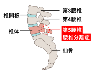 【公式】柏で「腰椎分離症」専門の治療・整体