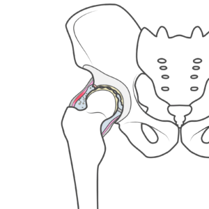 【柏市の整体】子どもの頃、ペルテス病を経験した方が、大人になって変形性股関節症や股関節痛を発症。整体で手術を回避できます！