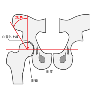 単純性股関節炎