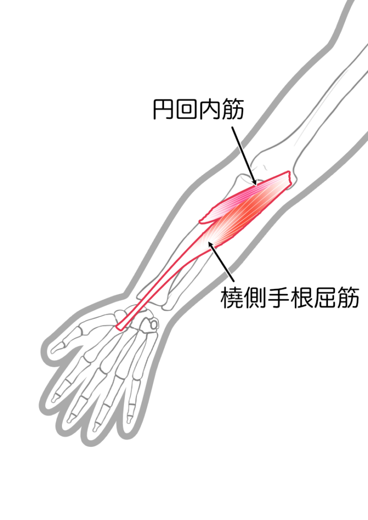 ゴルフ肘（上腕骨内側上顆炎）の原因となる前腕の筋肉3