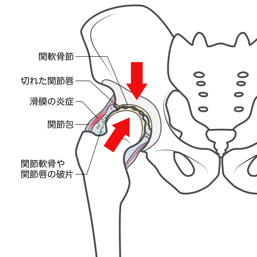 股関節の痛みのメカニズム