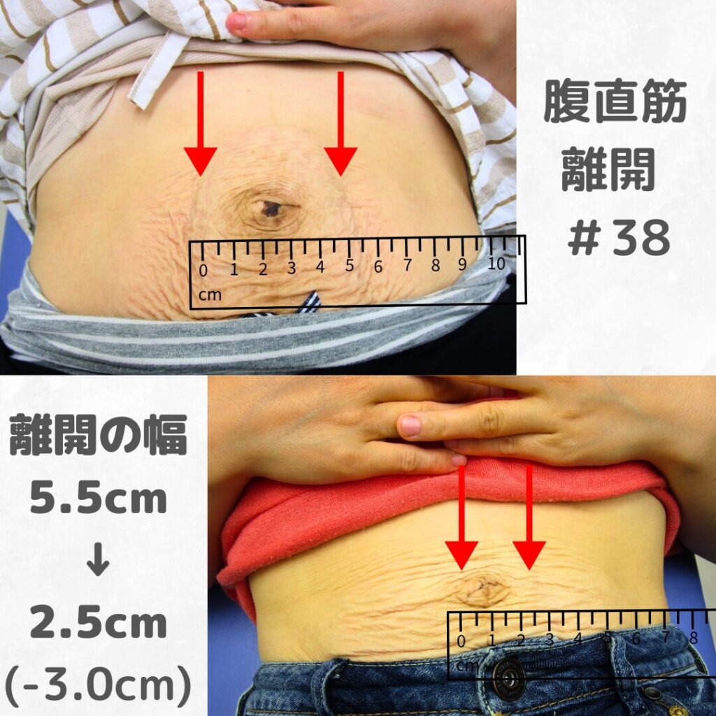 【やぎはし整体院】腹直筋離開の改善④