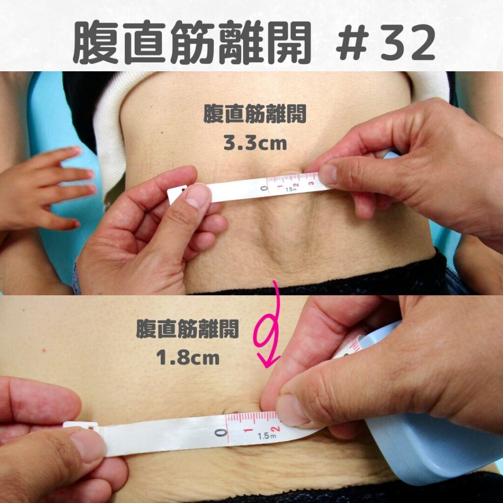 【やぎはし整体院】腹直筋離開の改善⑤